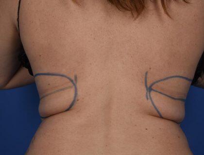 CoolSculpting Before & After Image