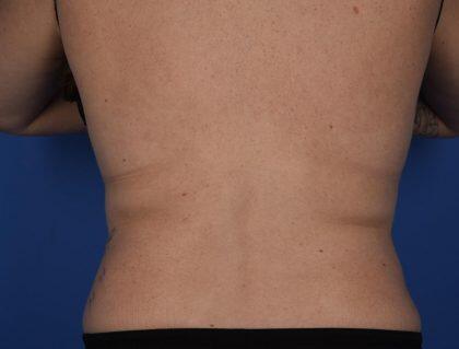 CoolSculpting Before & After Image