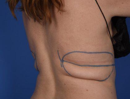 CoolSculpting Before & After Image