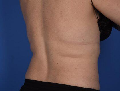 CoolSculpting Before & After Image