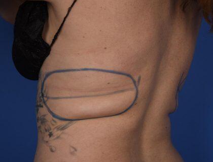 CoolSculpting Before & After Image