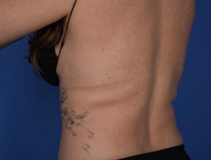 CoolSculpting Before & After Image