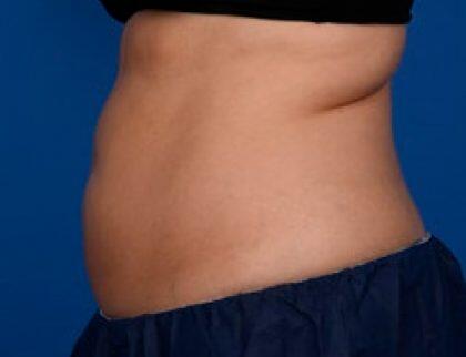 CoolSculpting Before & After Image