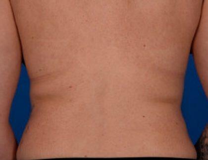 CoolSculpting Before & After Image