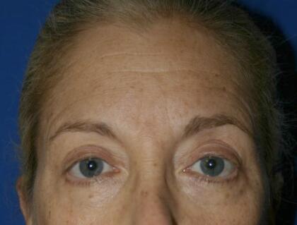 Fillers Before & After Image