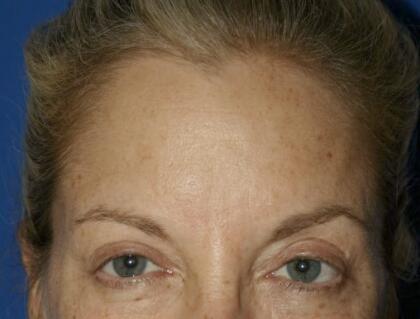 Fillers Before & After Image