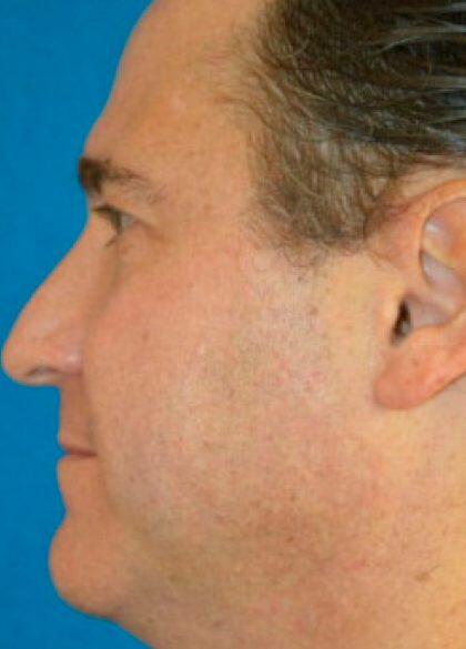 Kybella Before & After Image