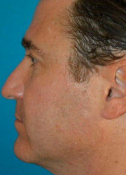 Kybella Before & After Image