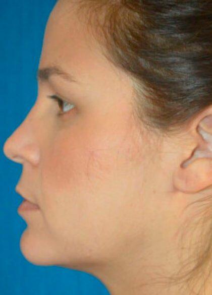 Kybella Before & After Image